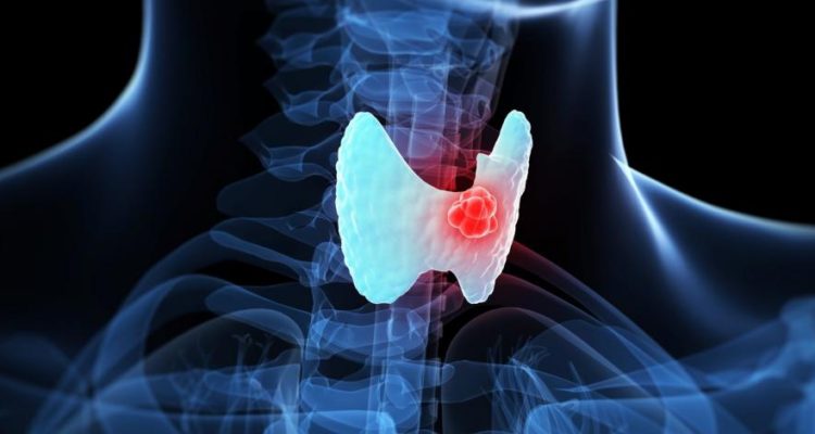 ThyroidPrint: Test de Diagnóstico del Cáncer de Tiroides
